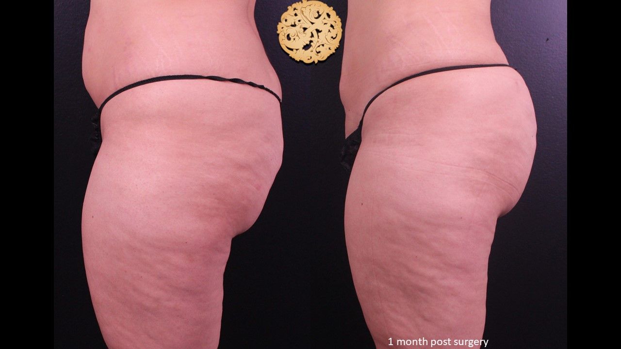 Fat Transfer Buttocks Before & After