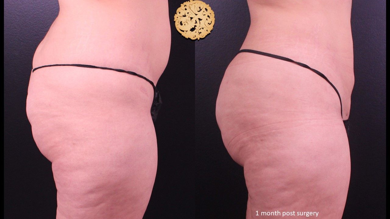 Fat Transfer Buttocks Before & After