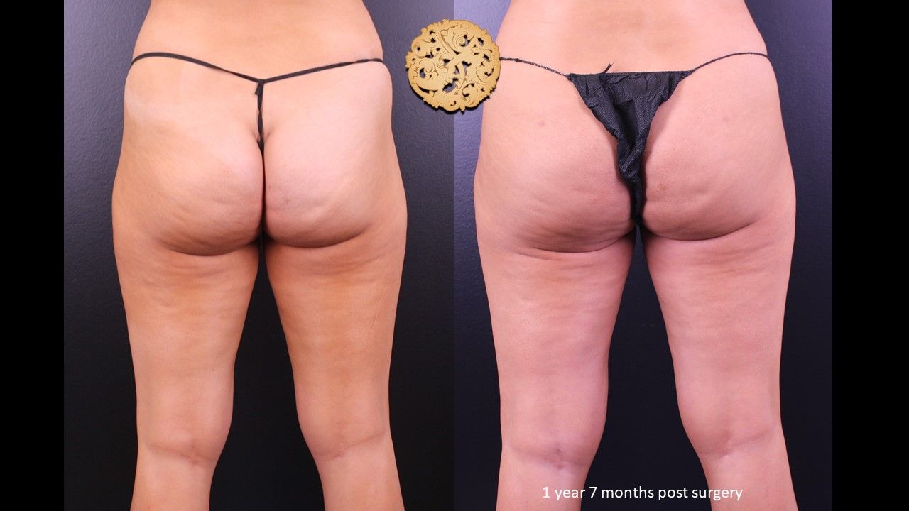 Fat Transfer Buttocks Before & After