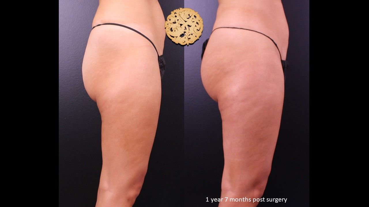 Fat Transfer Buttocks Before & After