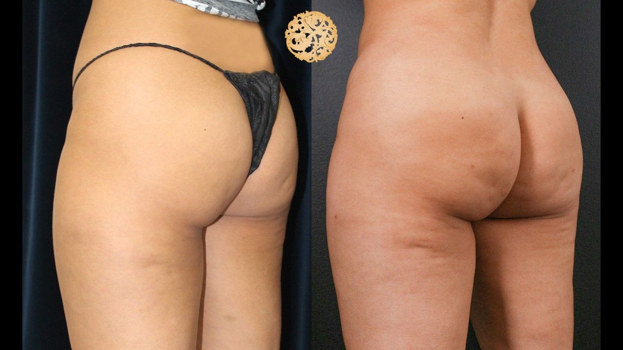 Fat Transfer Buttocks Before & After