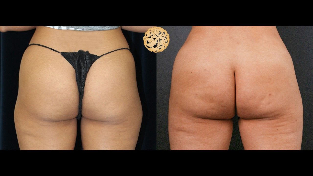 Fat Transfer Buttocks Before & After