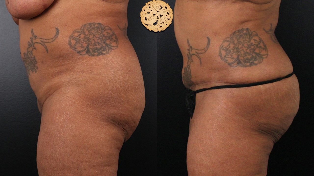 Fat Transfer Buttocks Before & After