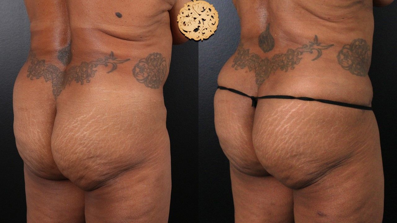 Fat Transfer Buttocks Before & After