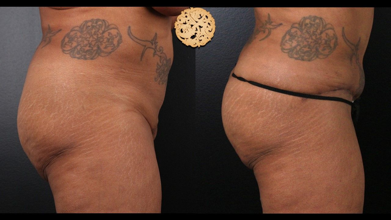 Fat Transfer Buttocks Before & After