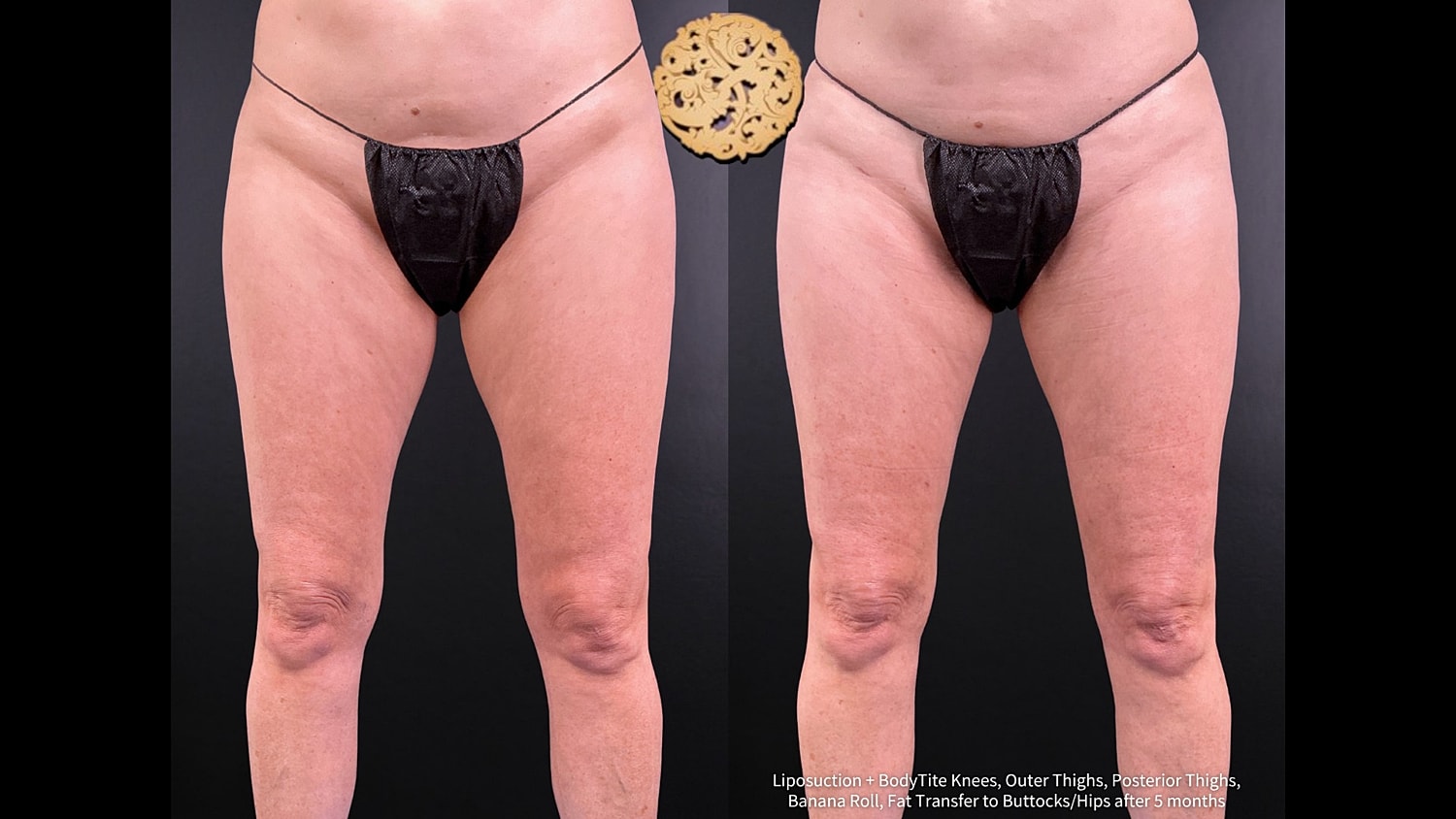 Fat Transfer Buttocks Before & After