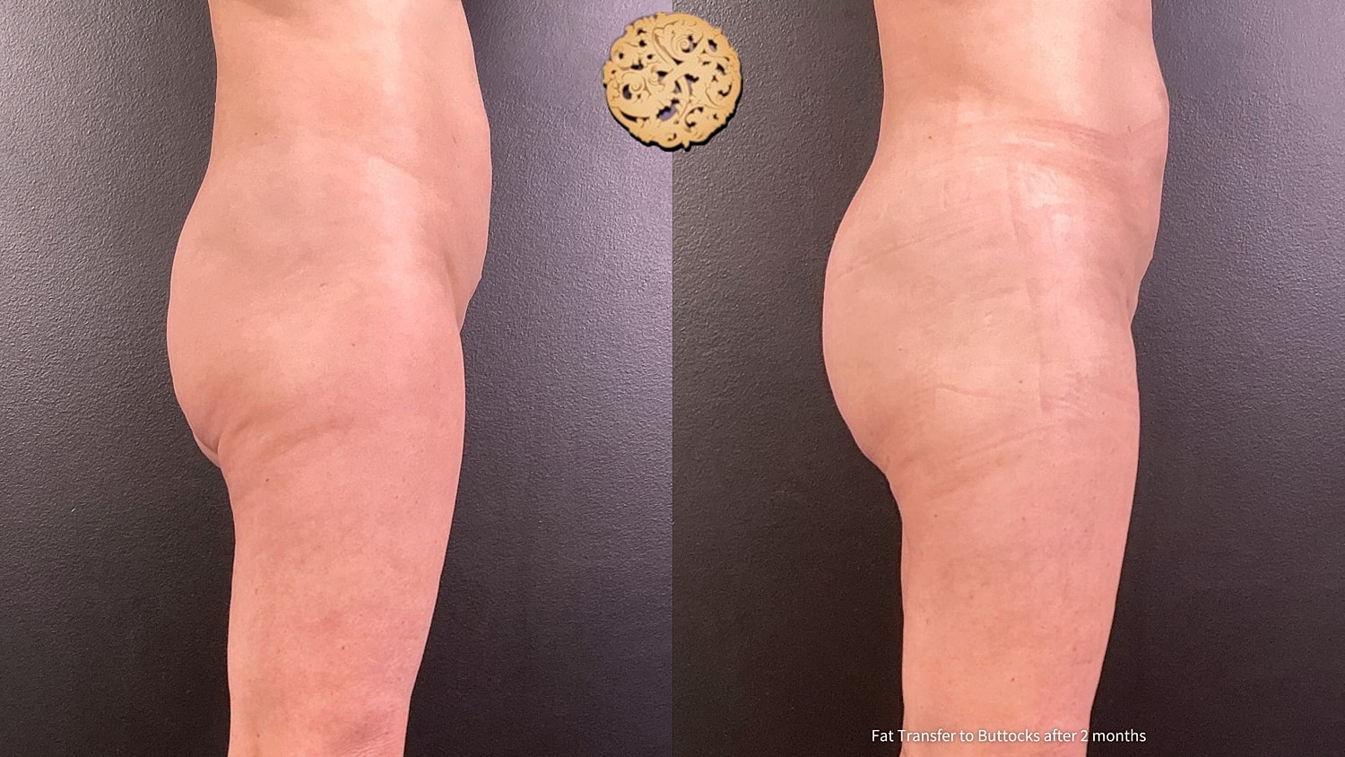 Fat Transfer Buttocks Before & After
