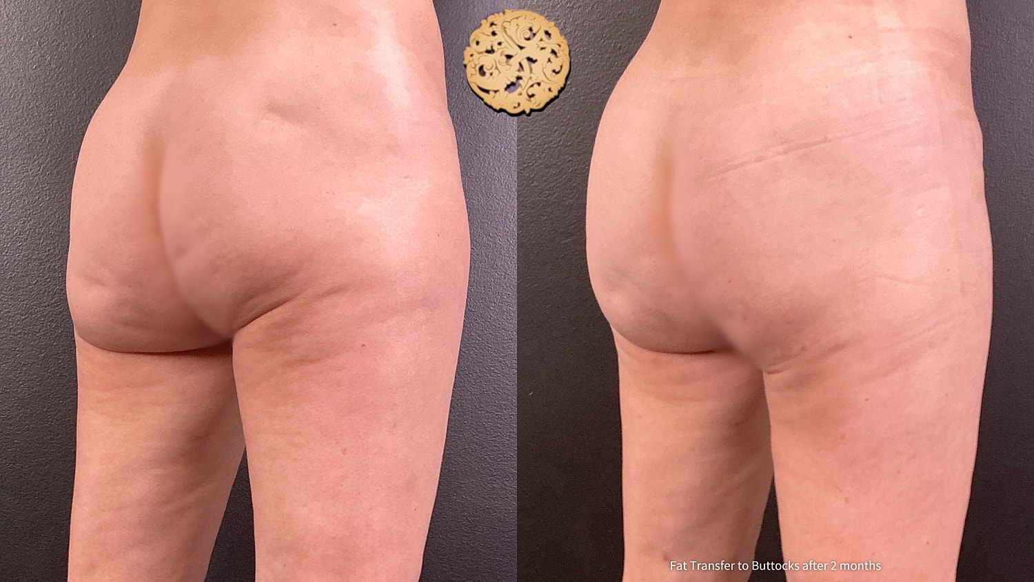 Fat Transfer Buttocks Before & After