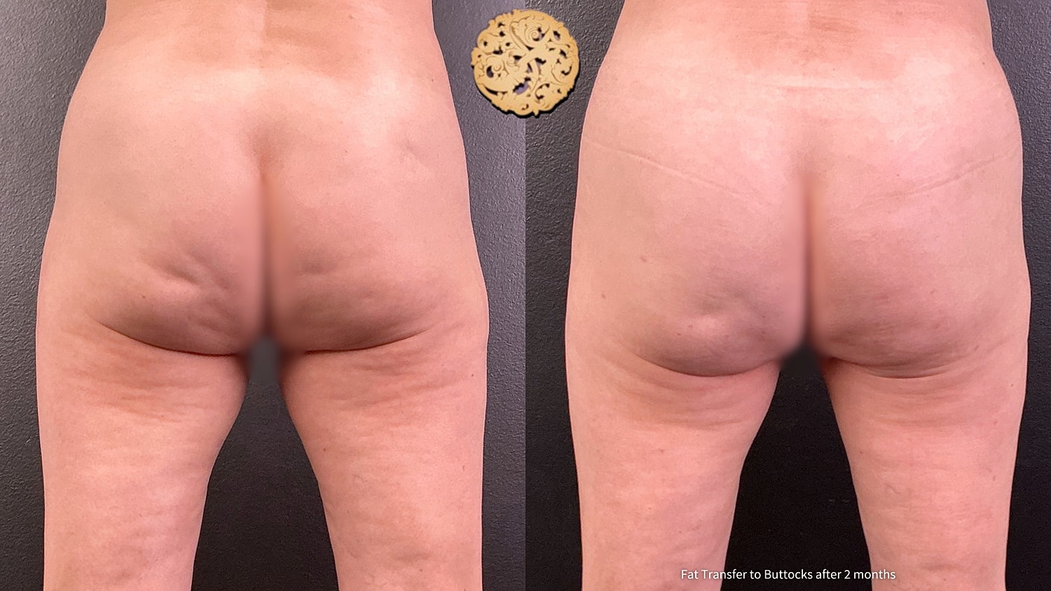 Fat Transfer Buttocks Before & After