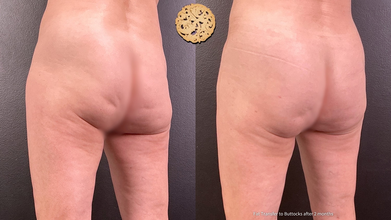 Fat Transfer Buttocks Before & After