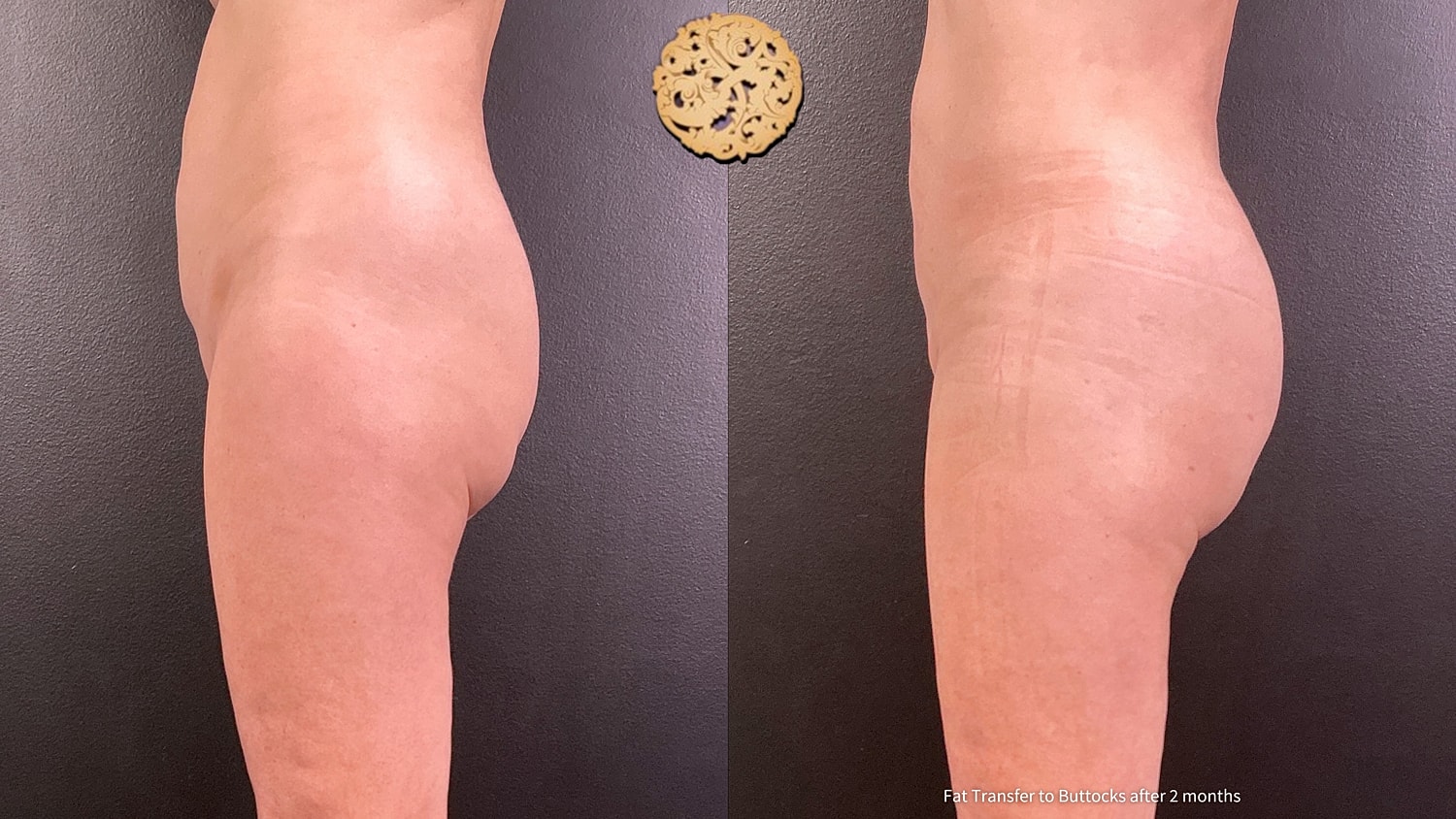 Fat Transfer Buttocks Before & After