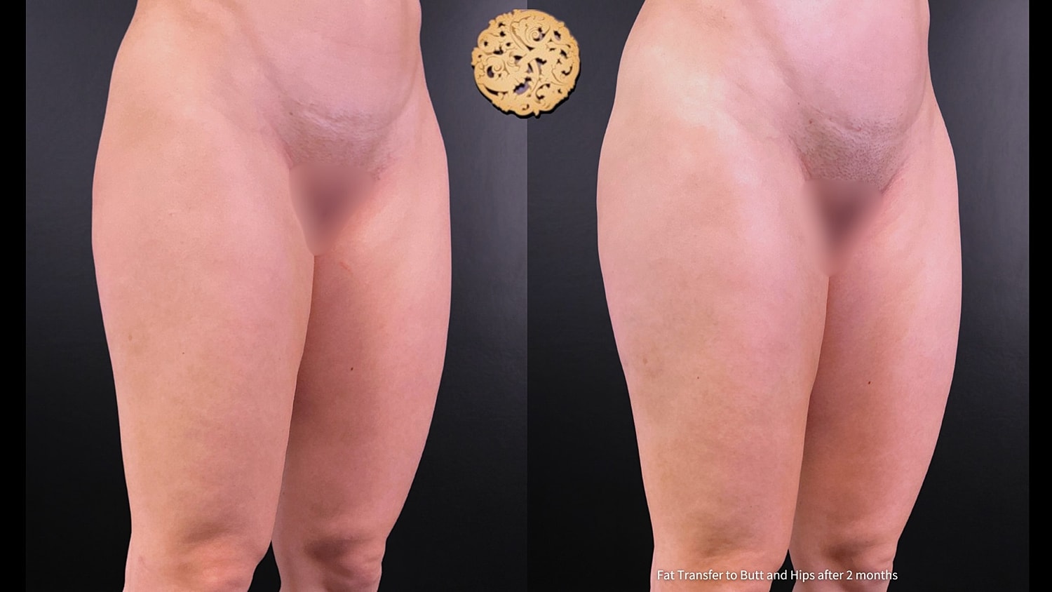 Fat Transfer Buttocks Before & After