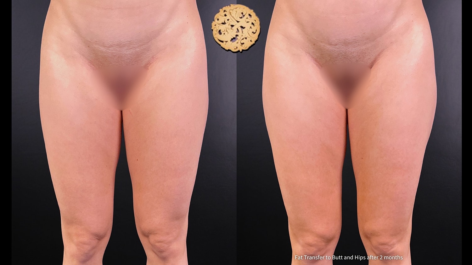 Fat Transfer Buttocks Before & After