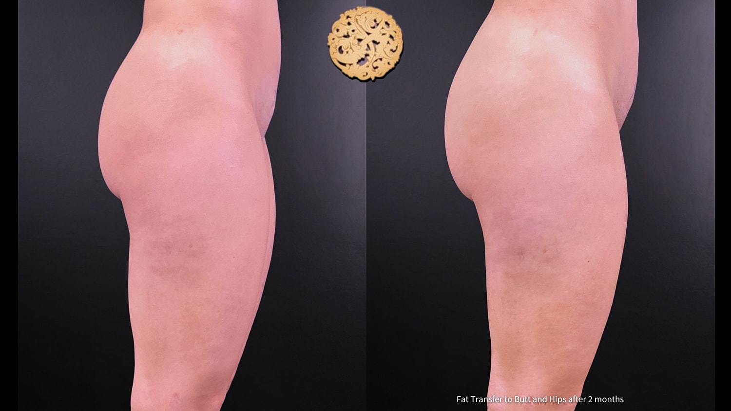 Fat Transfer Buttocks Before & After