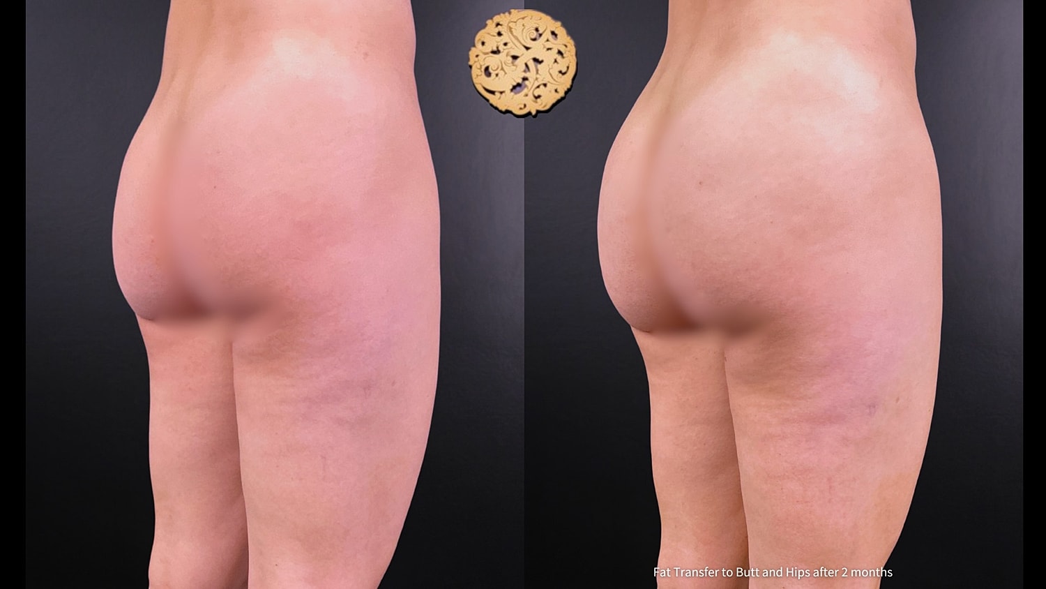 Fat Transfer Buttocks Before & After