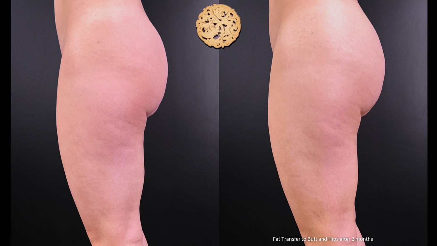 Fat Transfer Buttocks Before & After