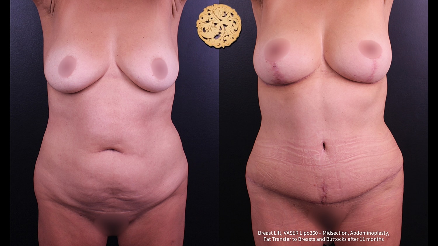 Fat Transfer Buttocks Before & After