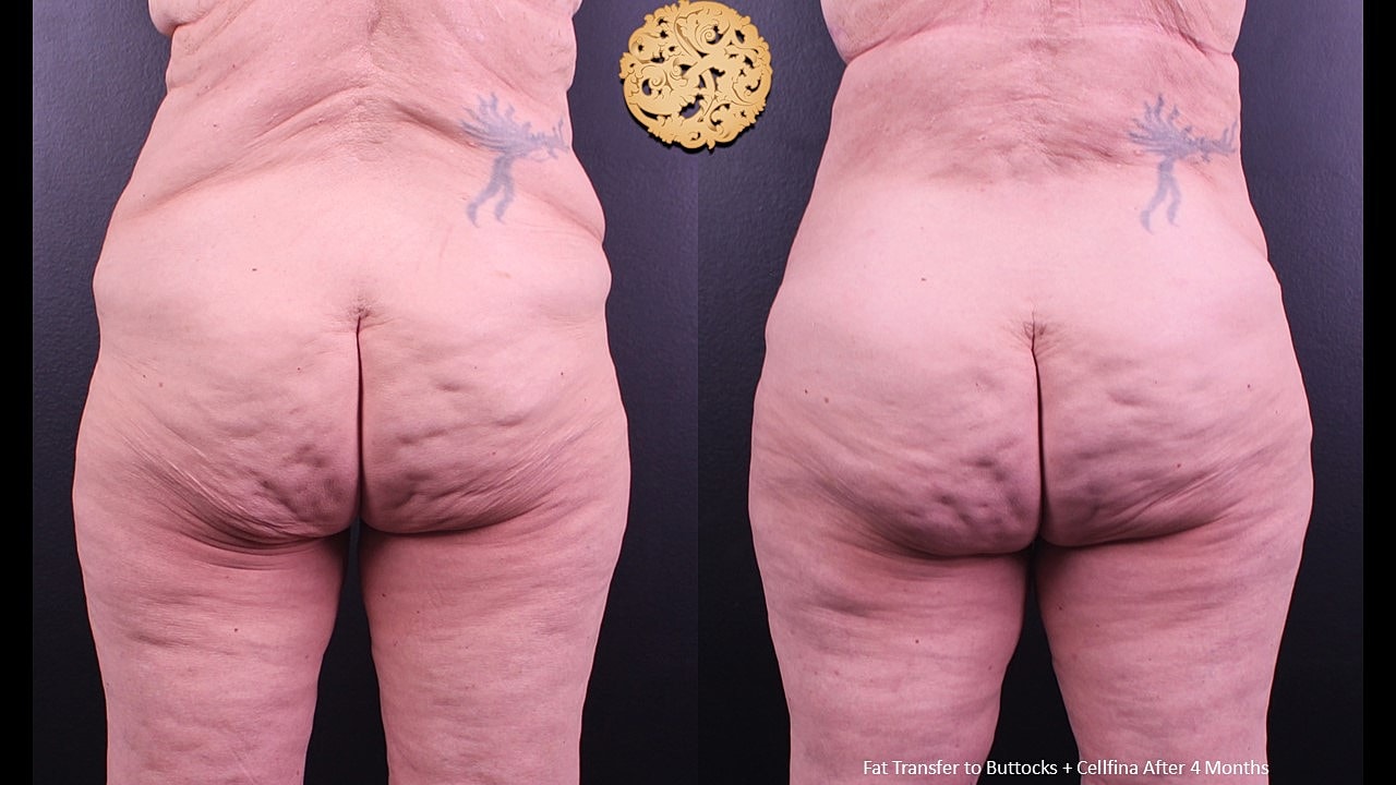 Fat Transfer Buttocks Before & After