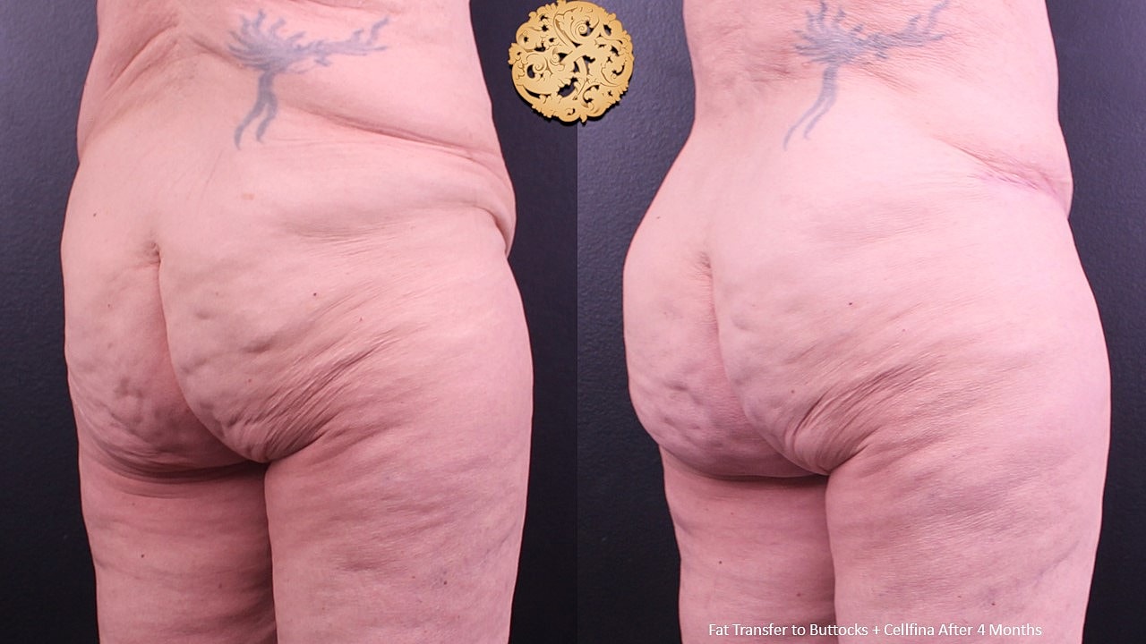 Fat Transfer Buttocks Before & After