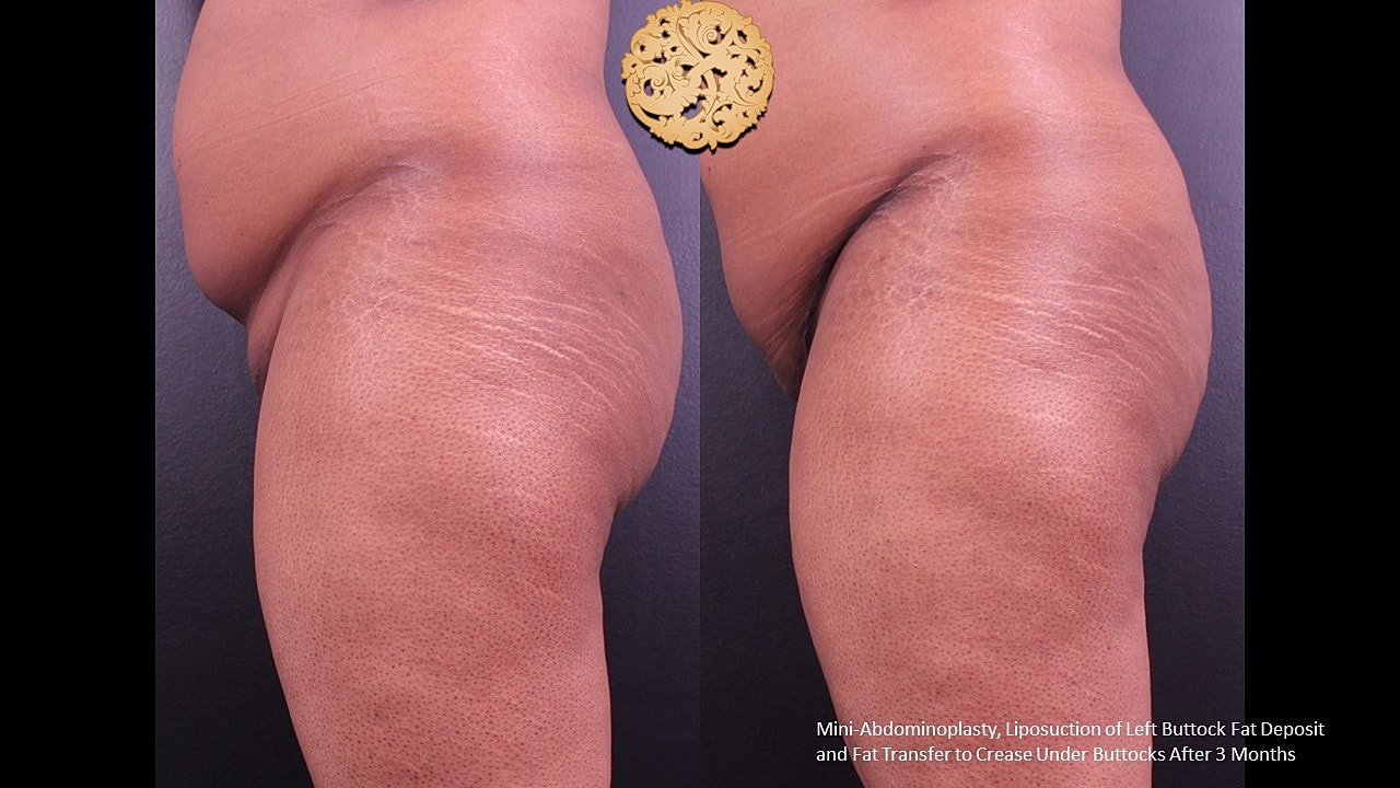 Fat Transfer Buttocks Before & After