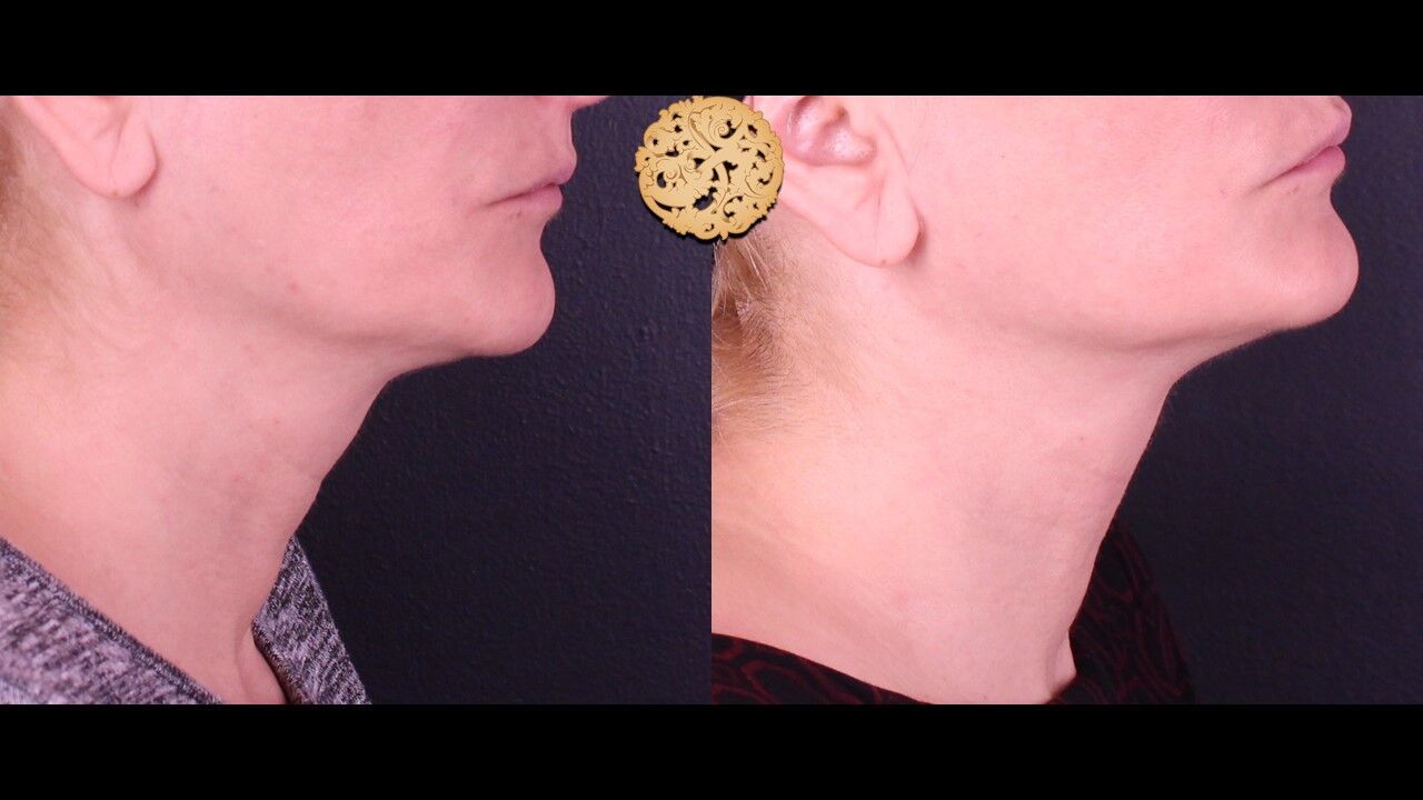 Neck Filler Before & After