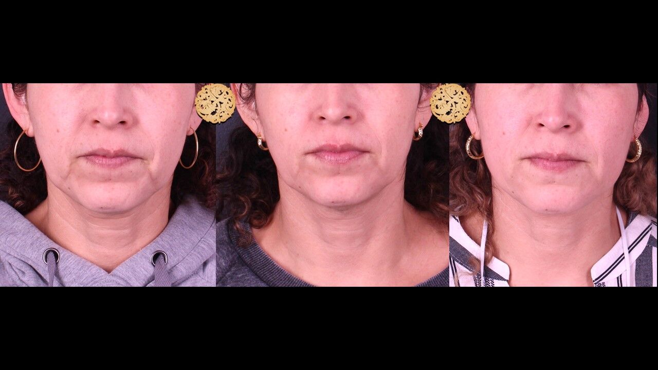 Neck Filler Before & After