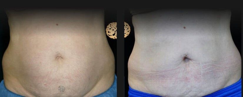 Abdomen Coolsculpting Before & After