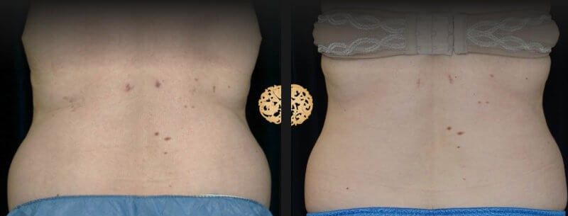 Abdomen Coolsculpting Before & After