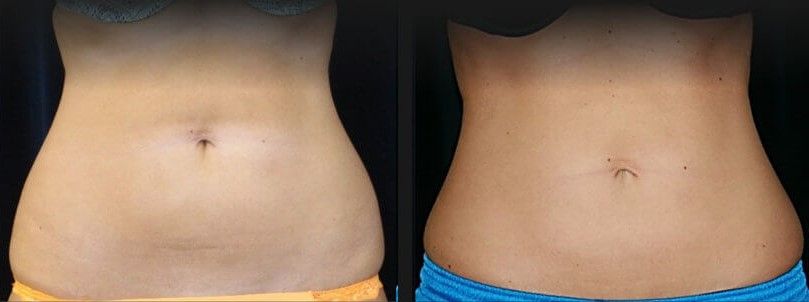 Abdomen Coolsculpting Before & After