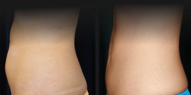 Abdomen Coolsculpting Before & After