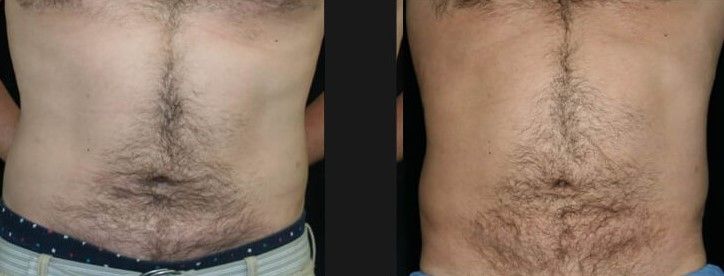 Abdomen Coolsculpting Before & After