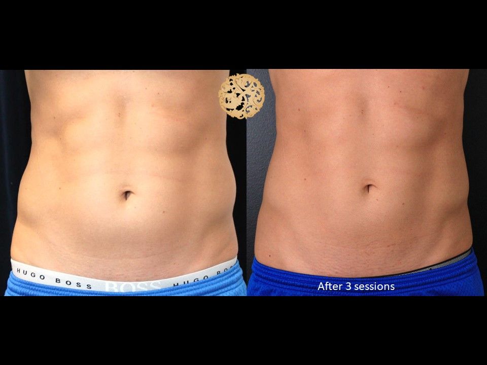 Abdomen Coolsculpting Before & After