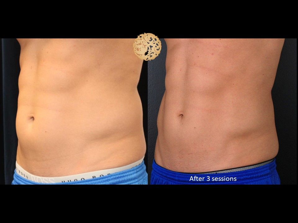 Abdomen Coolsculpting Before & After