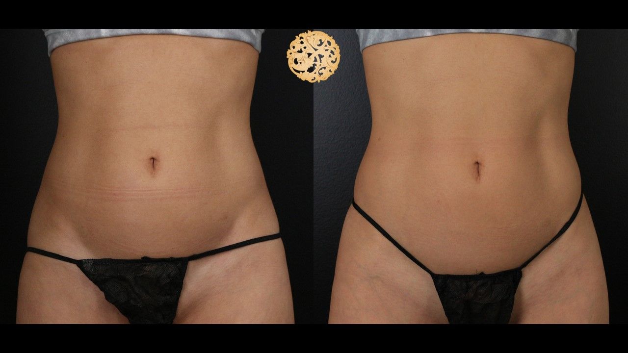 Abdomen Coolsculpting Before & After