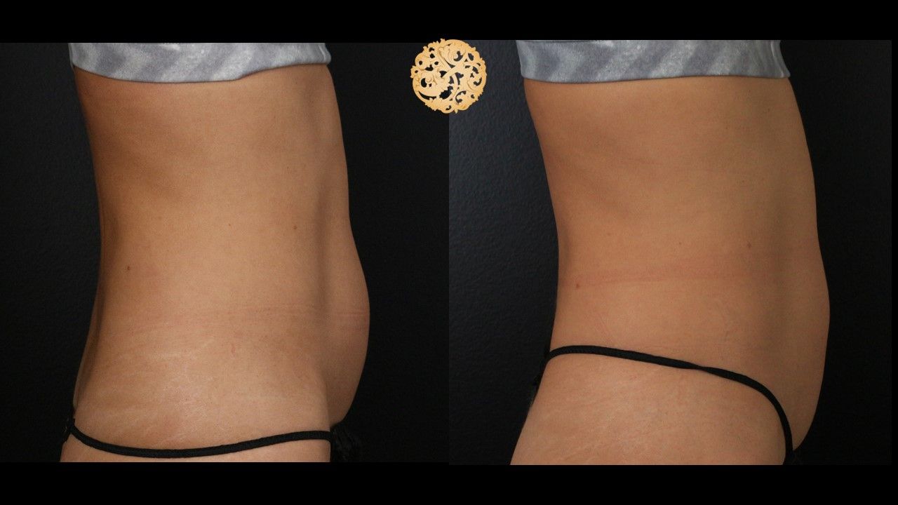 Abdomen Coolsculpting Before & After