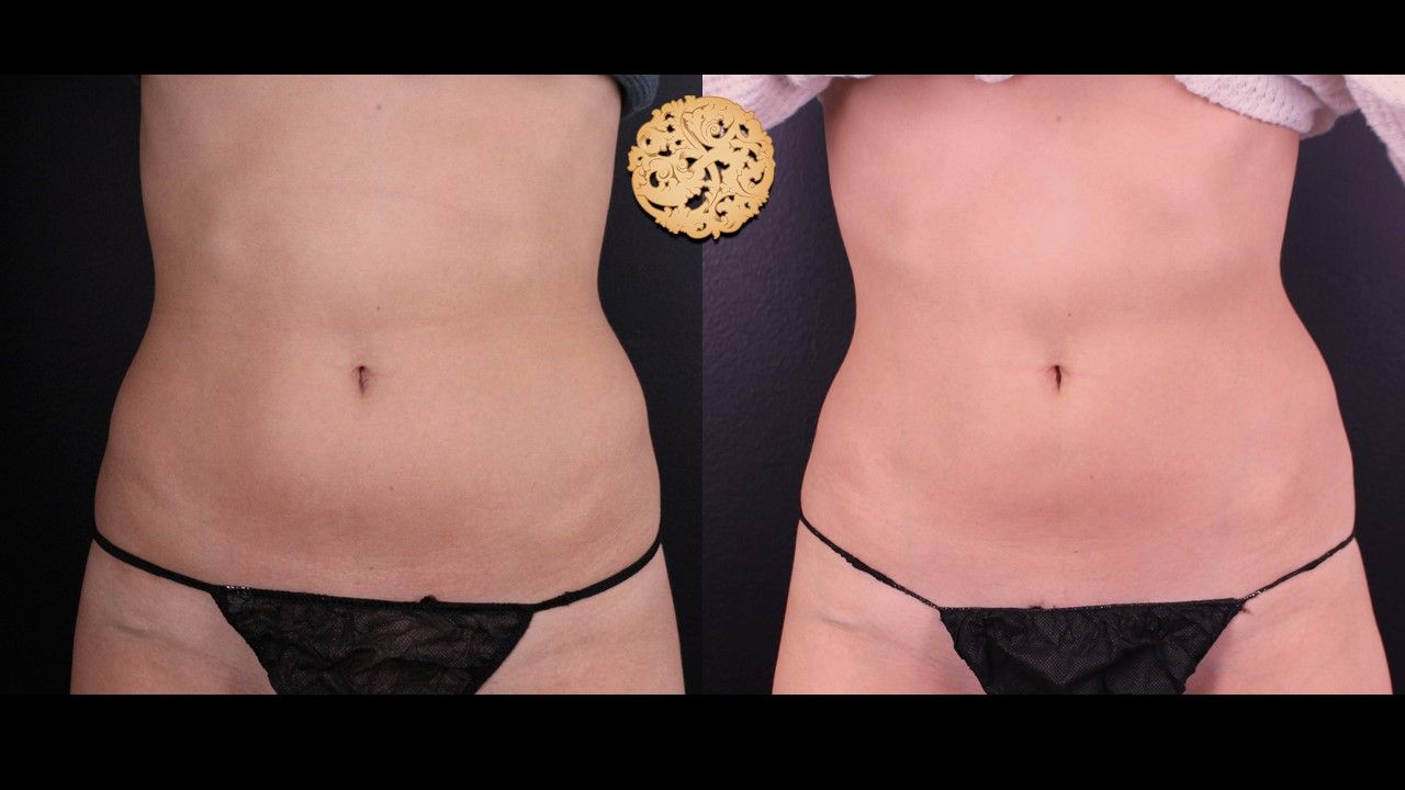 Abdomen Coolsculpting Before & After