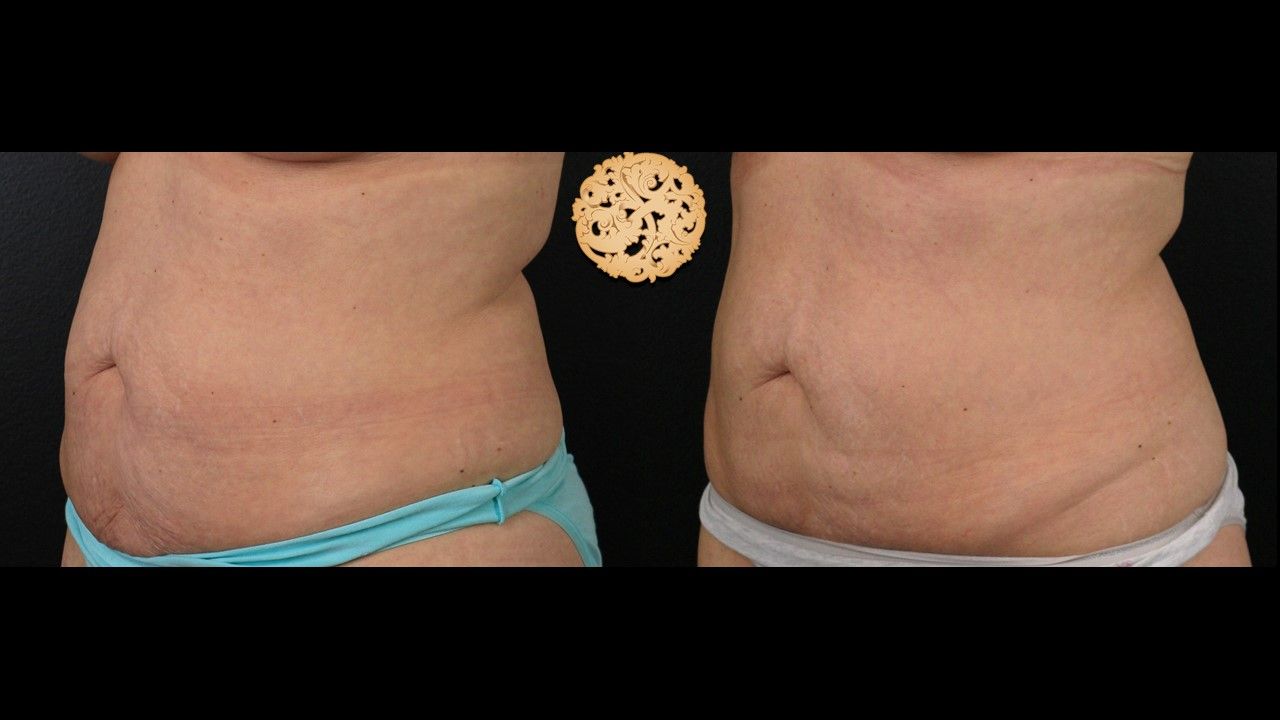 Abdomen Coolsculpting Before & After