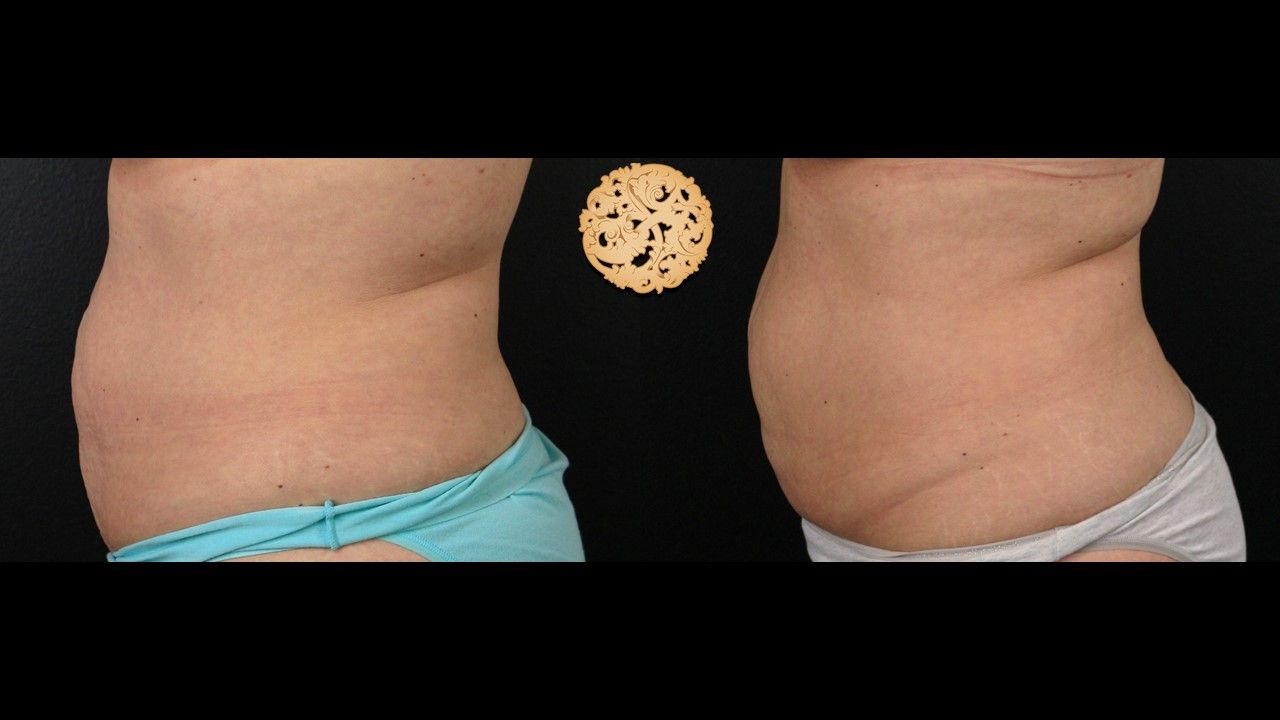 Abdomen Coolsculpting Before & After