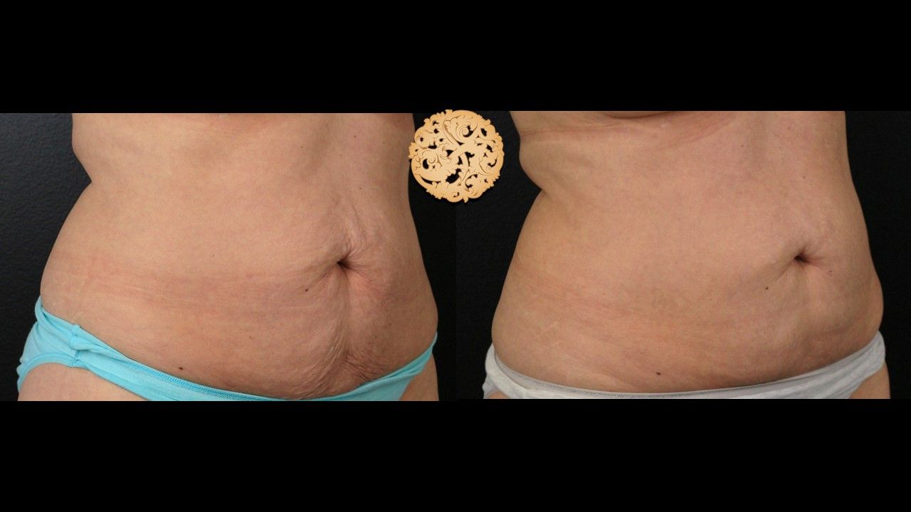 Abdomen Coolsculpting Before & After