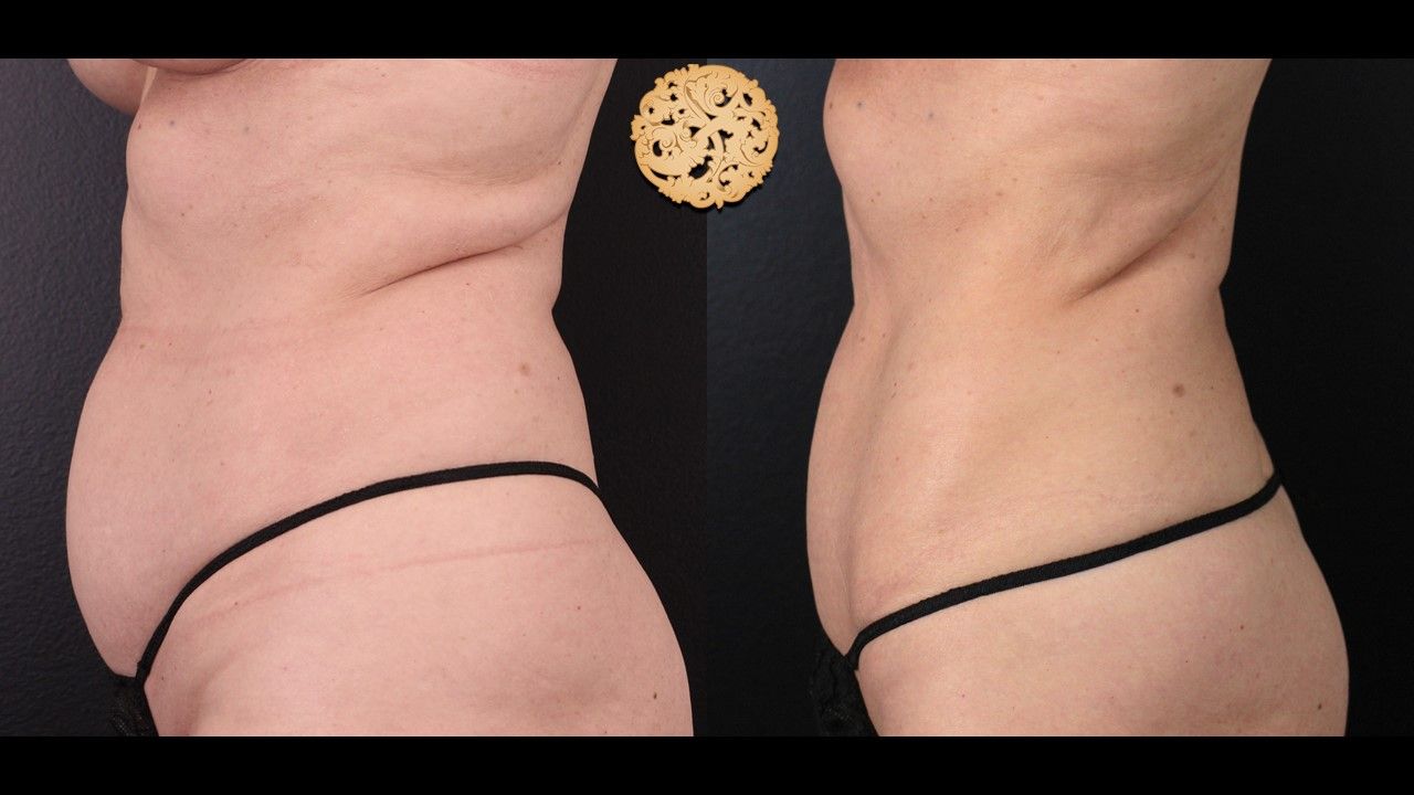 Abdomen Coolsculpting Before & After