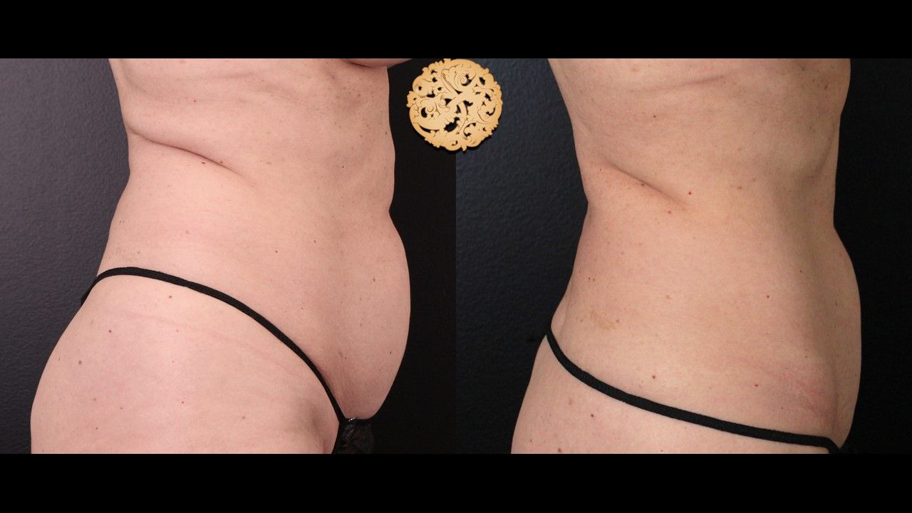 Abdomen Coolsculpting Before & After