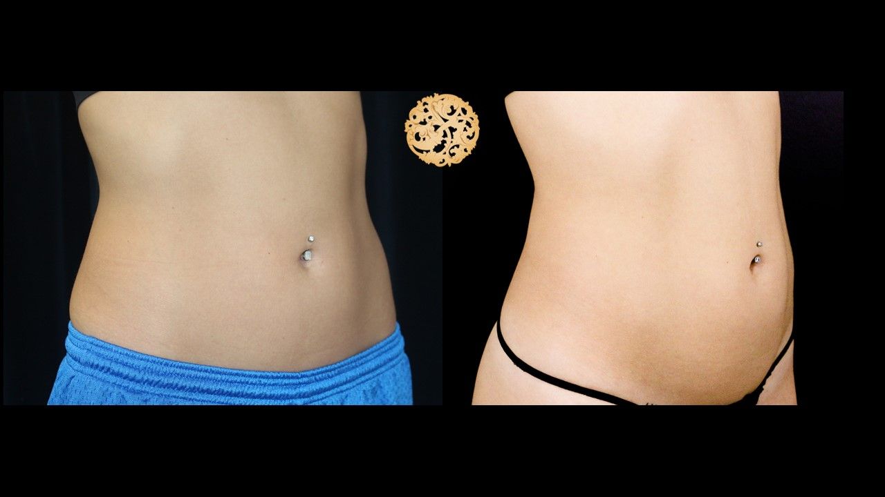 Abdomen Coolsculpting Before & After
