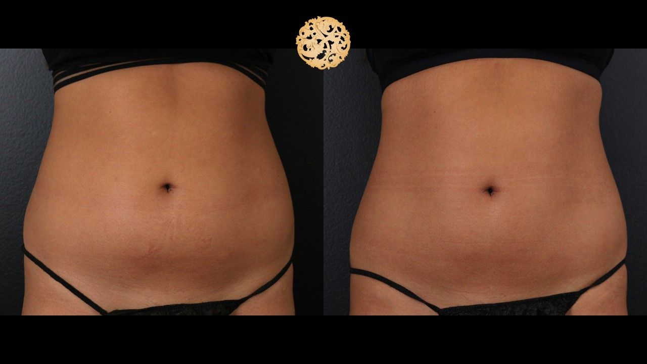 Abdomen Coolsculpting Before & After