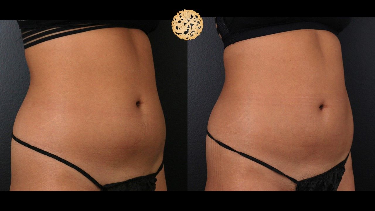 Abdomen Coolsculpting Before & After