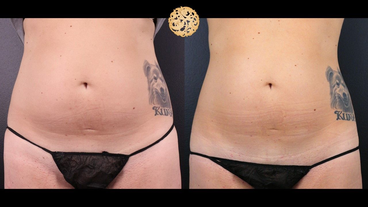 Abdomen Coolsculpting Before & After