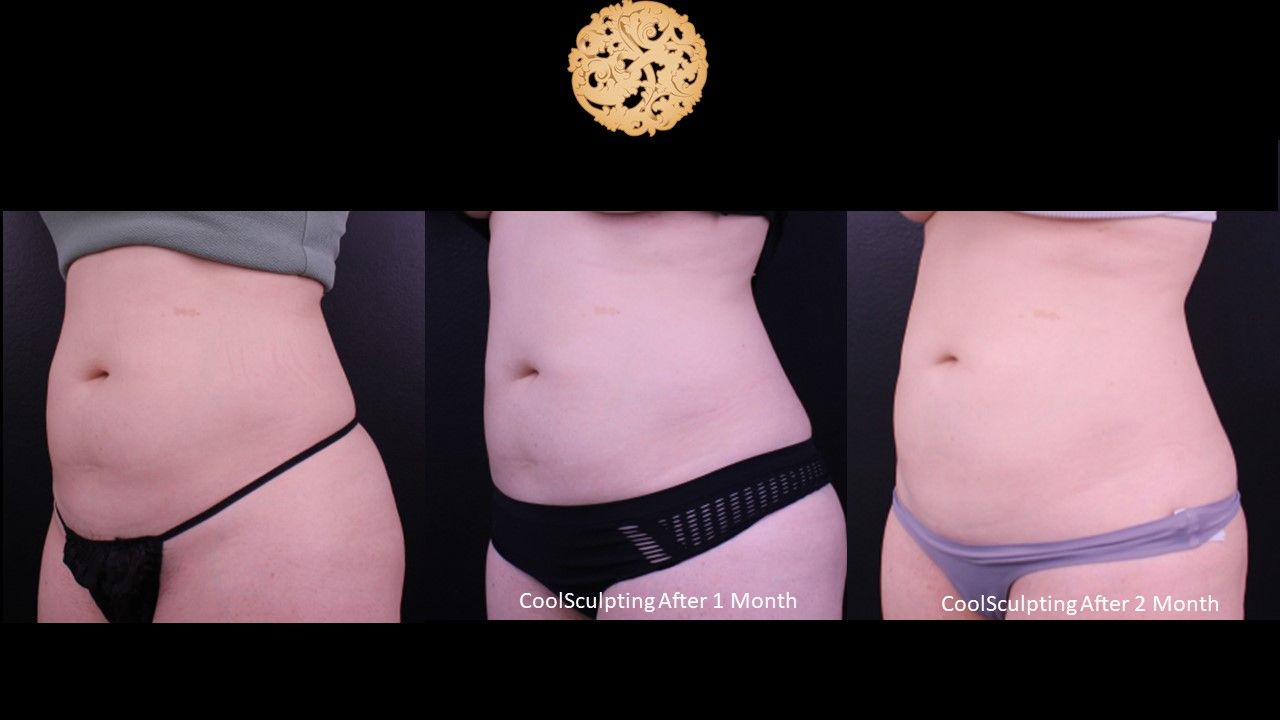 Abdomen Coolsculpting Before & After