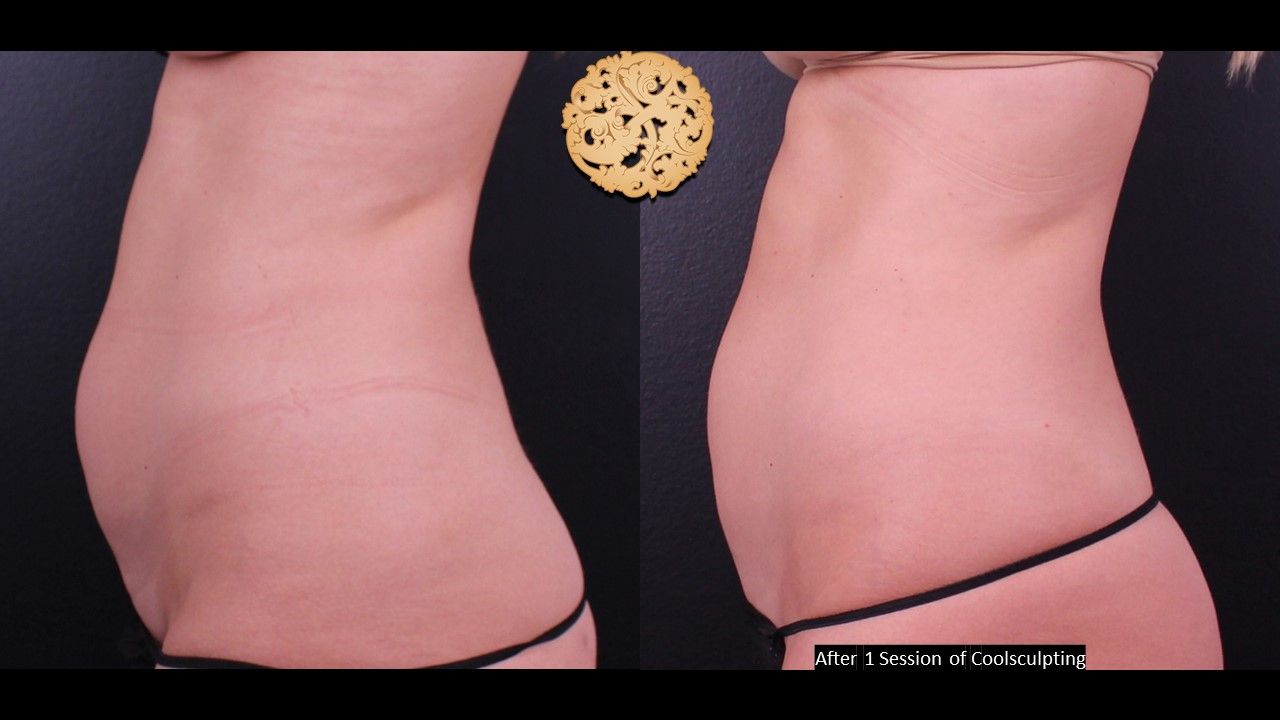 Abdomen Coolsculpting Before & After