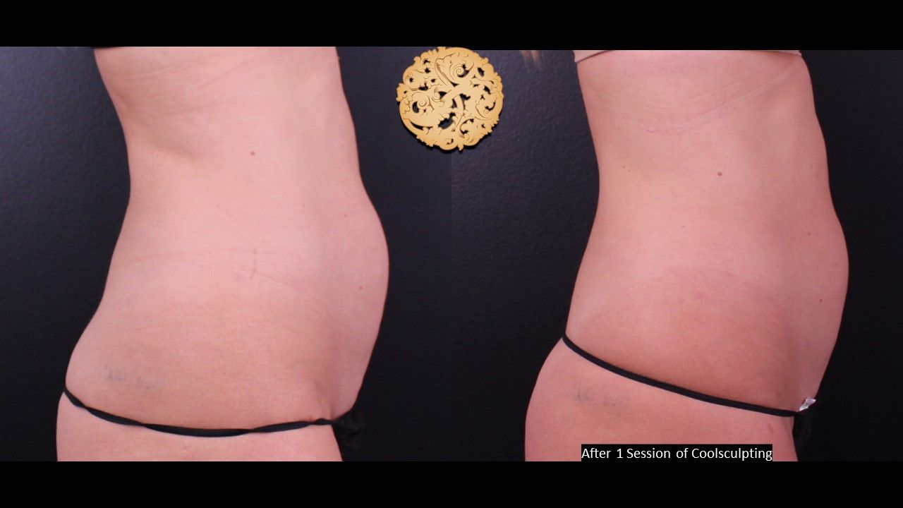 Abdomen Coolsculpting Before & After