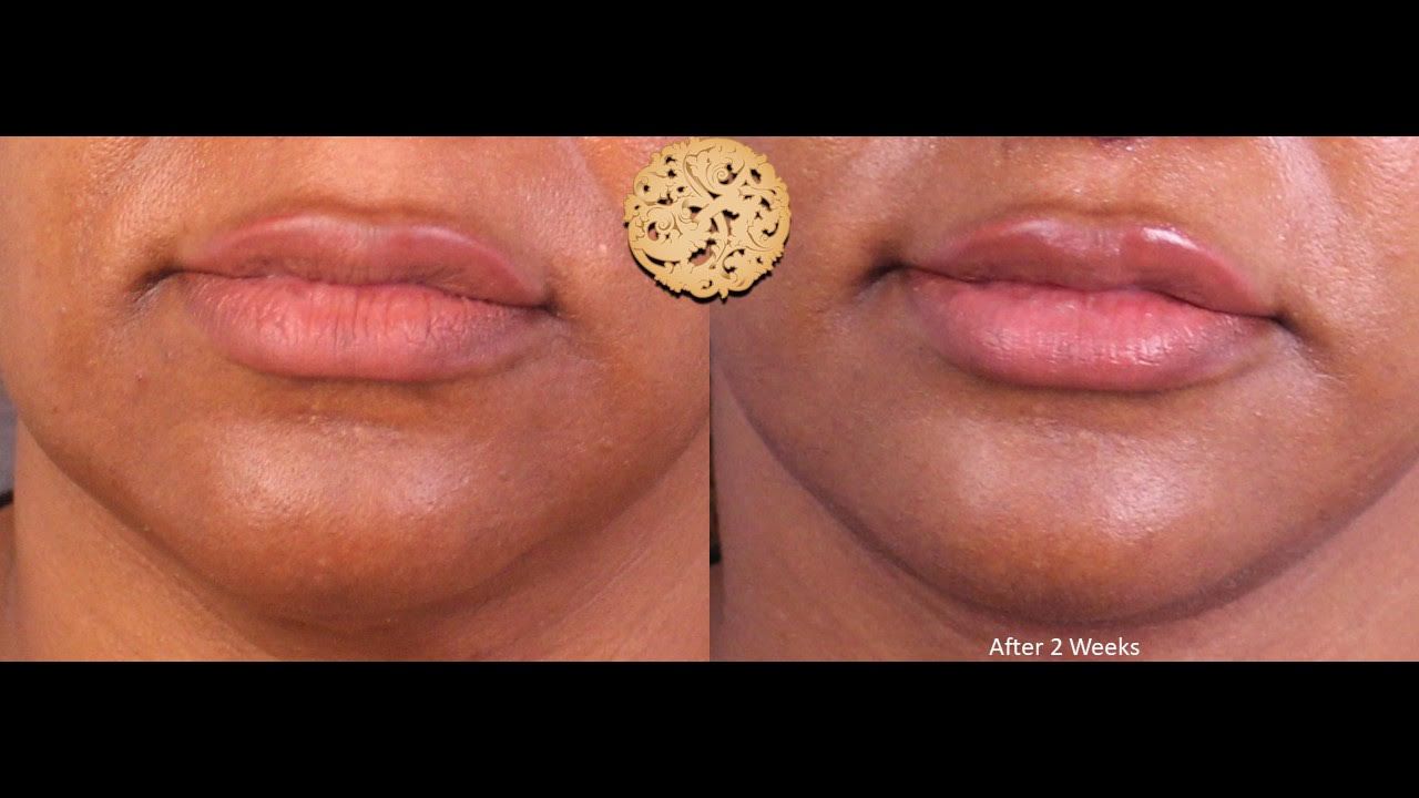 Fat Transfer To Lips Before & After