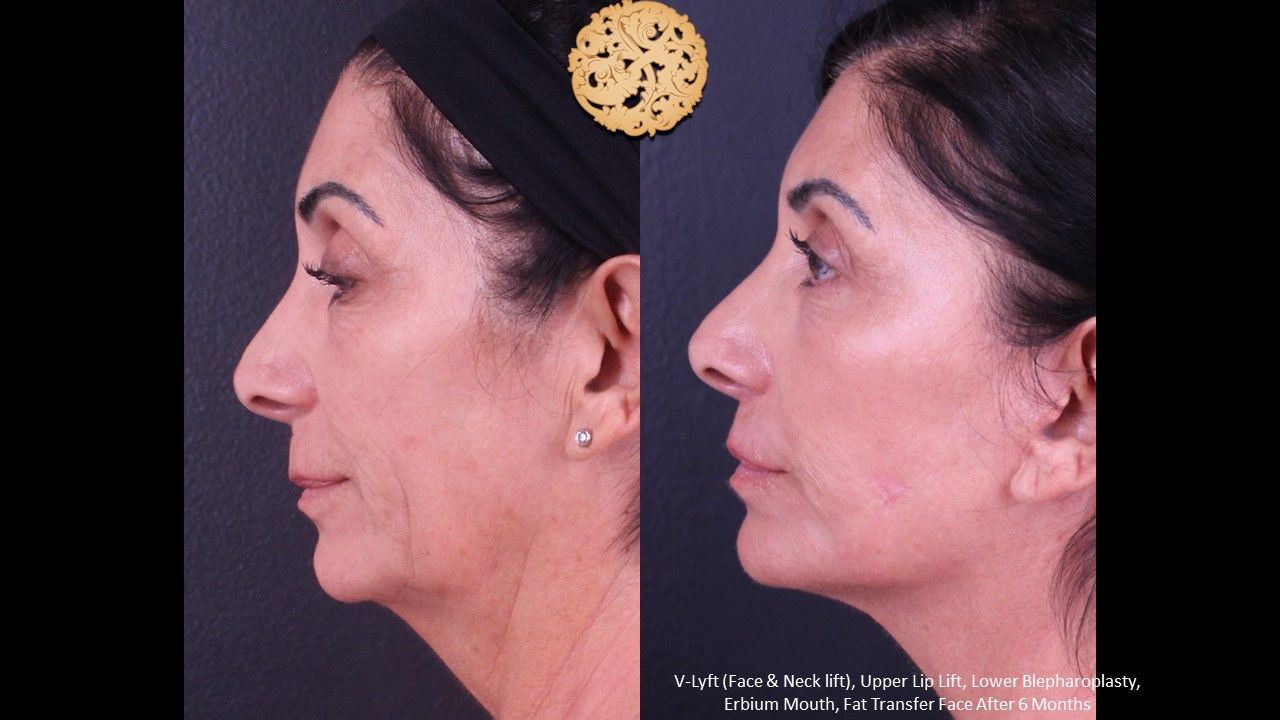 Erbium Laser Before & After